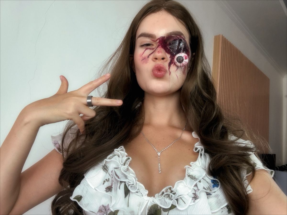 Ruptured eye prosthetic built over the eye socket
