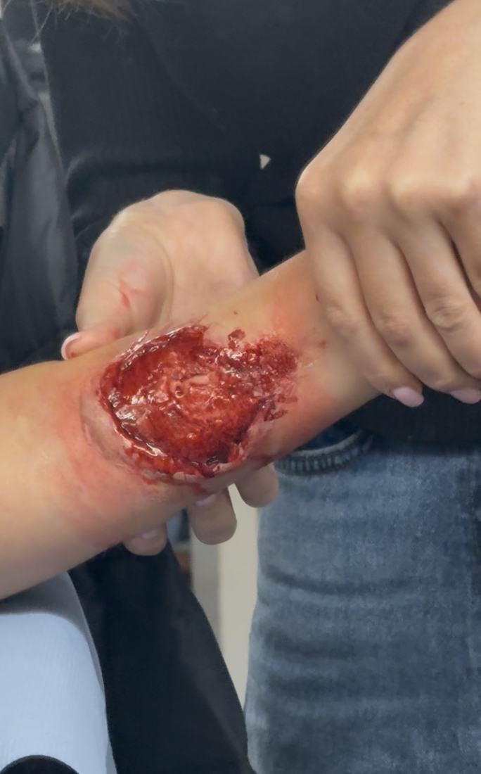 Deep avulsion wound on a forearm with exposed tissue