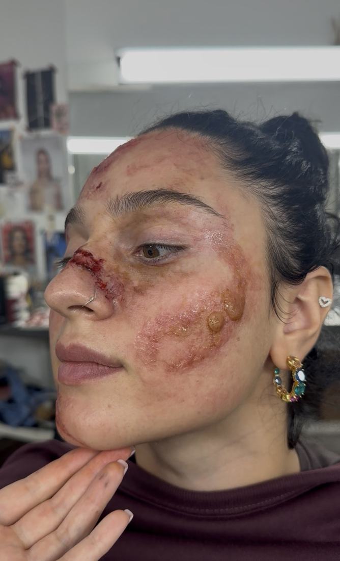 Second-degree burn across cheek and temple with blisters and a split nose bridge