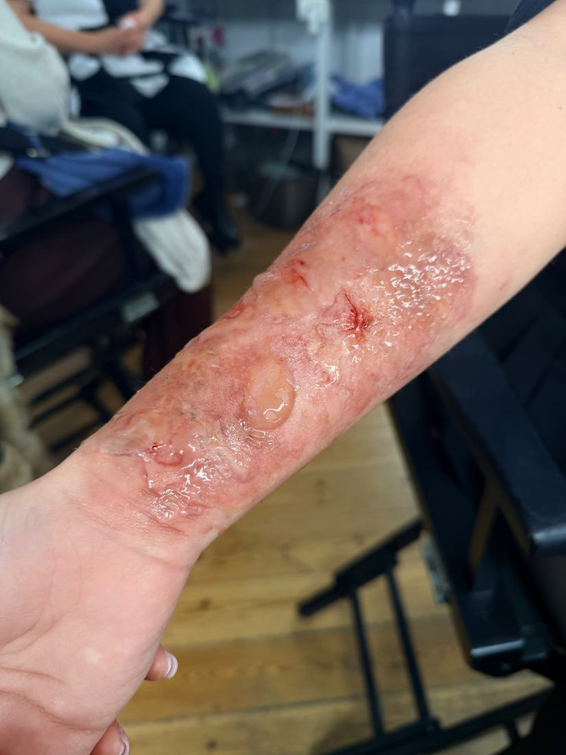 Scalding burn along a forearm with intact and broken blisters