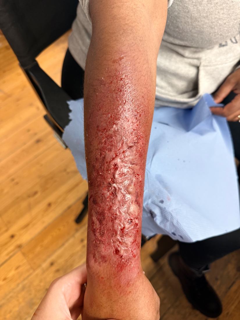 Extensive burn along a forearm, colour matched to a deeper skin tone