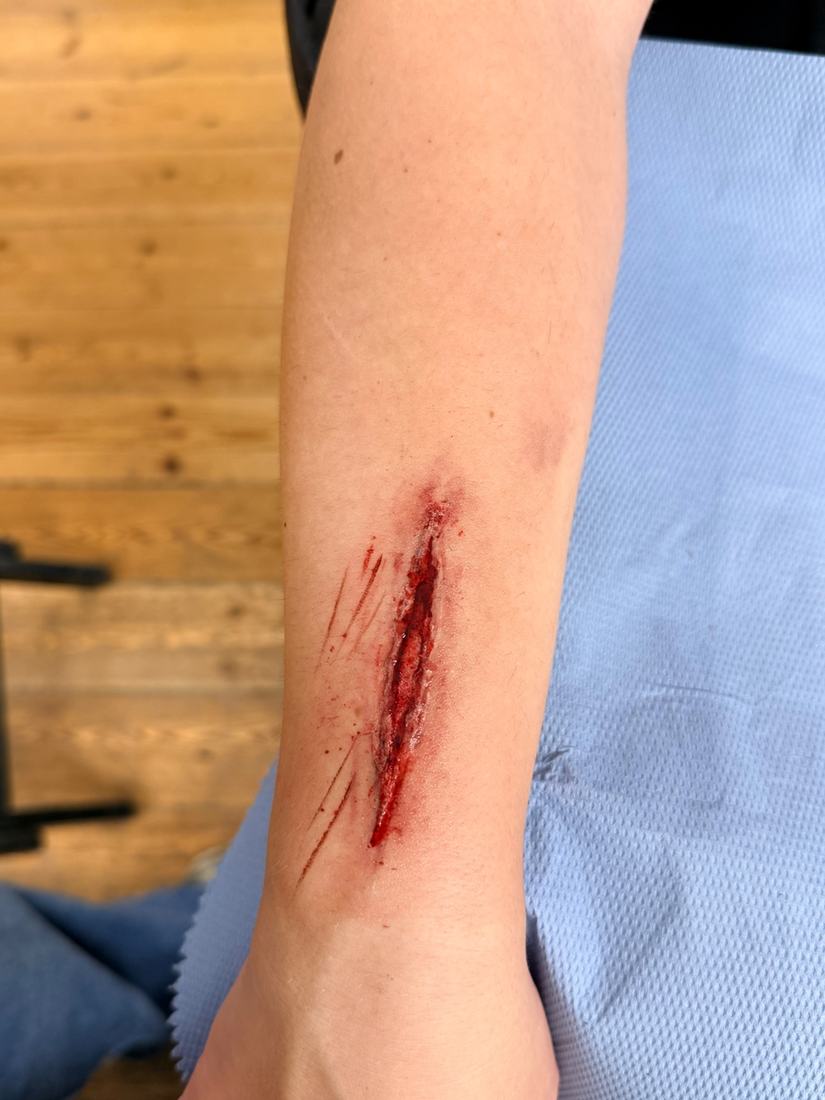Deep incised wound on a forearm with defensive cuts beside it